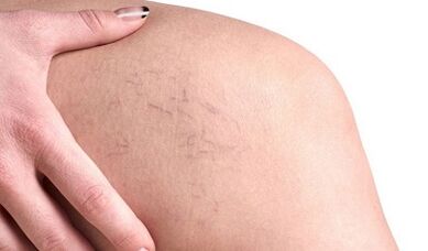 Cómo manifestar las venas varicosas en las mujeres