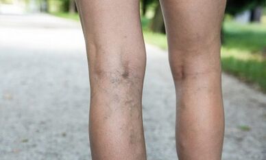 Las razones para el desarrollo de las venas varicosas en las mujeres