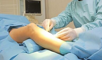 Métodos de operación para el tratamiento de las venas varicosas en mujeres