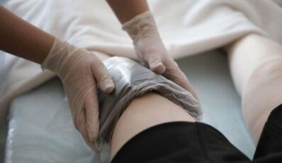 Métodos de personas para el tratamiento de las venas varicosas en mujeres