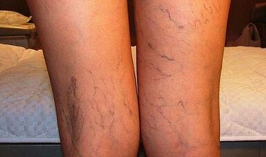 Síntomas de las venas varicosas en mujeres