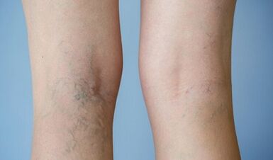 Signos de venas varicosas en las piernas en mujeres