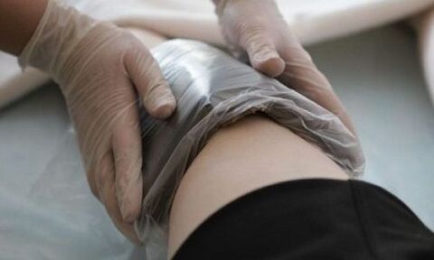 Tratamiento de varices con compresas.