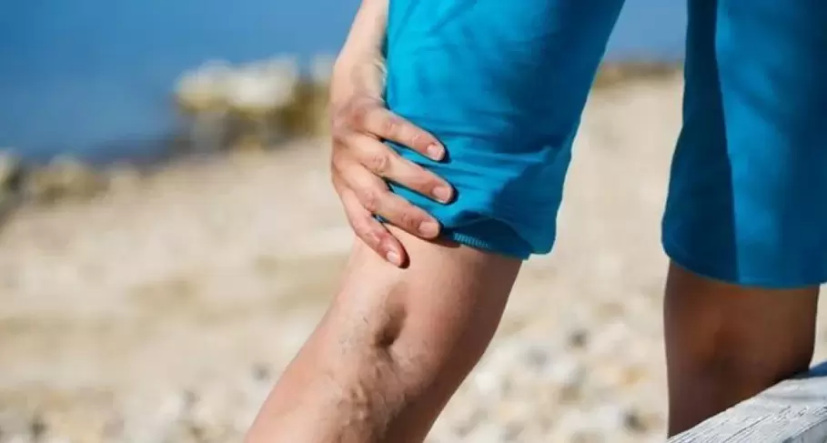 Venas varicosas en las piernas.