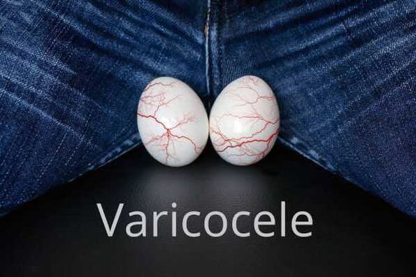 Varicocele agrandamiento de las venas del cordón espermático.